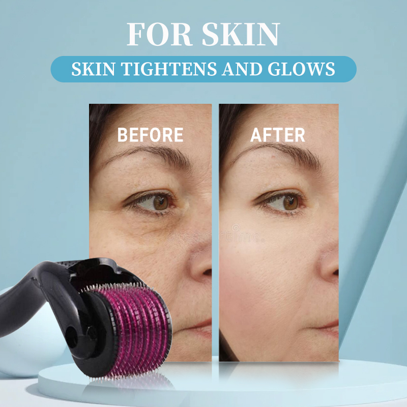Profesjonalny roller derma 540 – Derma Roller 0.25 recenzja i cena